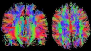 MRT-Bilder vom menschlichen Hirn